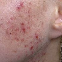 Signos del acné